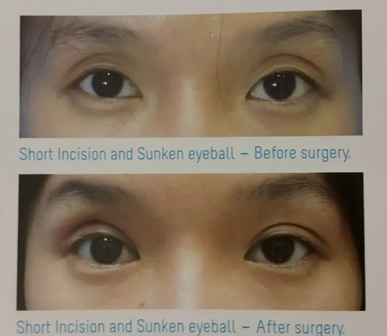 คนไทยและคนเอเชียประมาณ 50 เปอร์เซ็นต์มีเช...