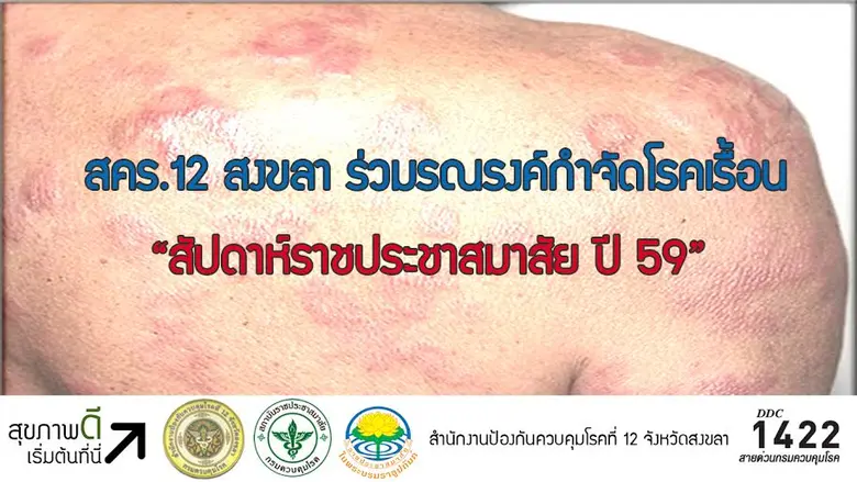 สำนักงานป้องกันควบคุมโรคที่ 12 จังหวัดสงข...