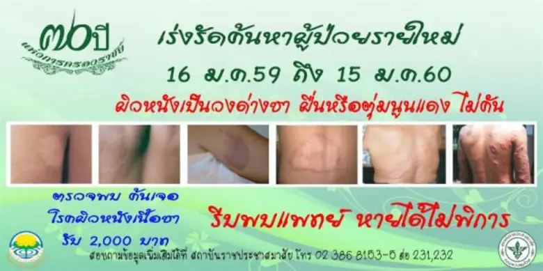 สคร.10 อุบลฯ ลุยค้นหาและกำจัดปัญหาโรคเรื้อน
