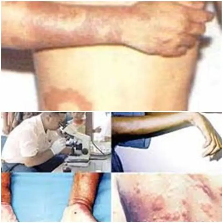 สคร.10 อุบลฯ ลุยค้นหาและกำจัดปัญหาโรคเรื้อน