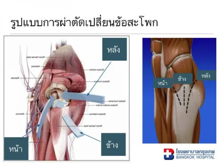 ศูนย์ข้อสะโพกและข้อเข่ากรุงเทพ โรงพยาบาลก...