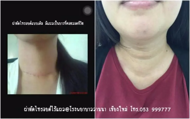 มิติใหม่ของการรักษาผู้ป่วยคอพอก ทีมศัลยแพทย์ รพ.ลานนา ผ่าตัดแบบส่องกล้องไร้รอยแผลเป็น