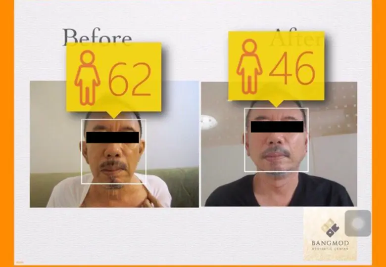 ศัลยแพทย์ รพ.บางมด เผย “เฟสออฟ เฟสล็อค เฟสลิฟท์” สิ่งที่ทุกคนต้องทำความเข้าใจก่อนทำศัลยกรรม