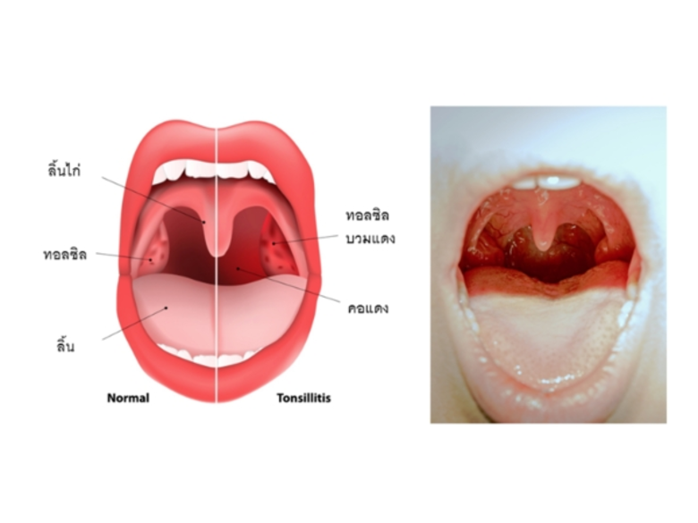โดย พญ.ศาธิณี ลิมปิสุข แพทย์เวชศาสตร์ทั่ว...