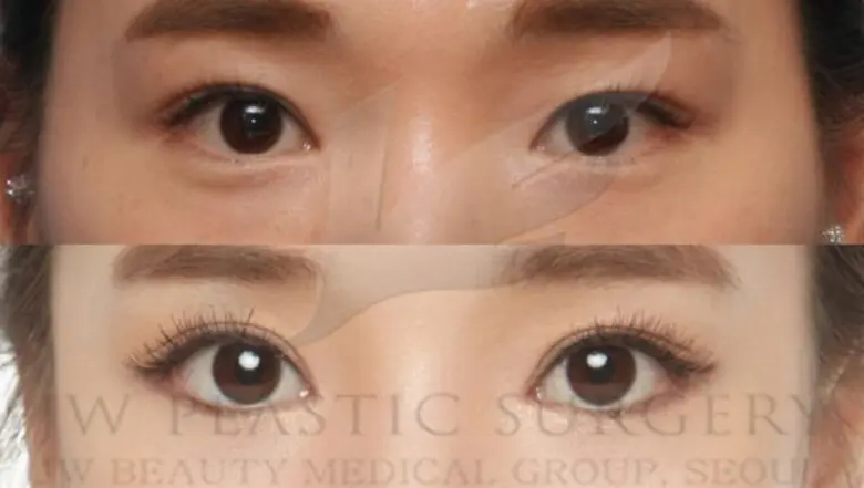 ศัลยแพทย์ชื่อดังจากเกาหลี ชี้เทรนด์ศัลยกรรมเอเชีย ตาสองชั้นกลมโตแบบสาวเกาหลี กับ จมูก S-Line มาแรงสุดๆๆ