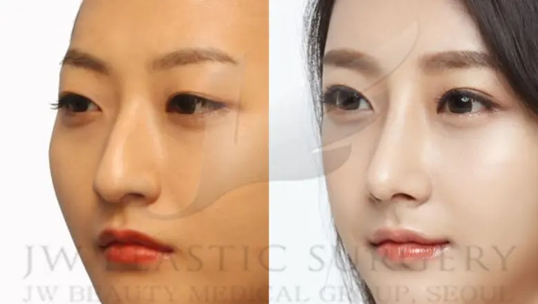 ศัลยแพทย์ชื่อดังจากเกาหลี ชี้เทรนด์ศัลยกรรมเอเชีย ตาสองชั้นกลมโตแบบสาวเกาหลี กับ จมูก S-Line มาแรงสุดๆๆ