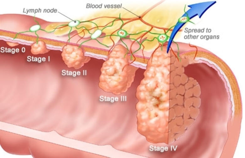 มะเร็งลำไส้ใหญ่ รู้เร็ว คัดกรองเร็ว ป้องกันโรค 90 %