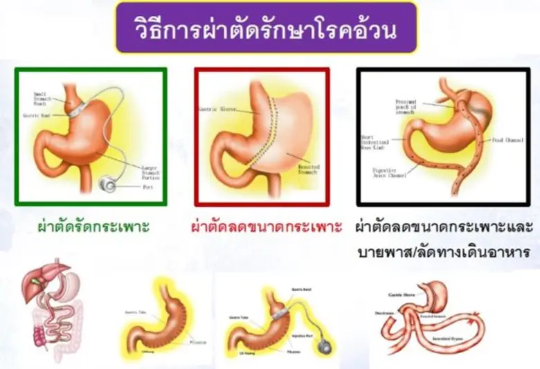 อุบัติการณ์โรคอ้วนและนวัตกรรมการรักษาสมัยใหม่ด้วยวิธีการผ่าตัด