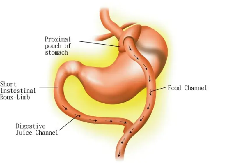 อุบัติการณ์โรคอ้วนและนวัตกรรมการรักษาสมัยใหม่ด้วยวิธีการผ่าตัด