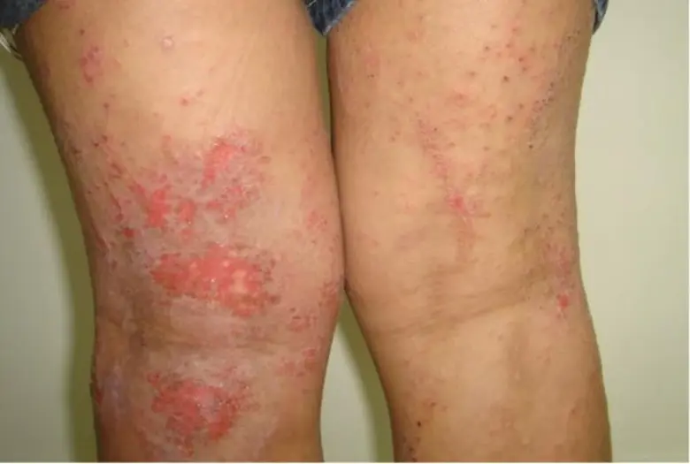 พ่อแม่ยุคใหม่รู้ทันโรคผื่นภูมิแพ้ผิวหนังในเด็ก