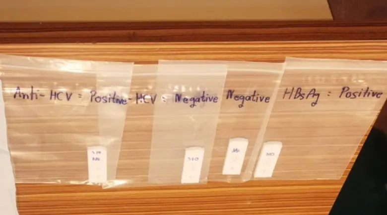 28 กรกฎาคม วันโรคตับอักเสบโลก กรมควบคุมโรค ห่วงปัญหาโรคตับอักเสบ เตรียมนำร่องระบบเฝ้าระวังแบบบูรณาการในปี 2559 นี้