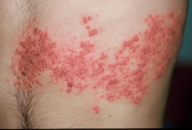 เรียนรู้ เรื่อง “งูสวัด” ศ.ดร.นพ.ประวิตร อัศวานนท์ ประชาสัมพันธ์สมาคมแพทย์ผิวหนังแห่งประเทศไทย