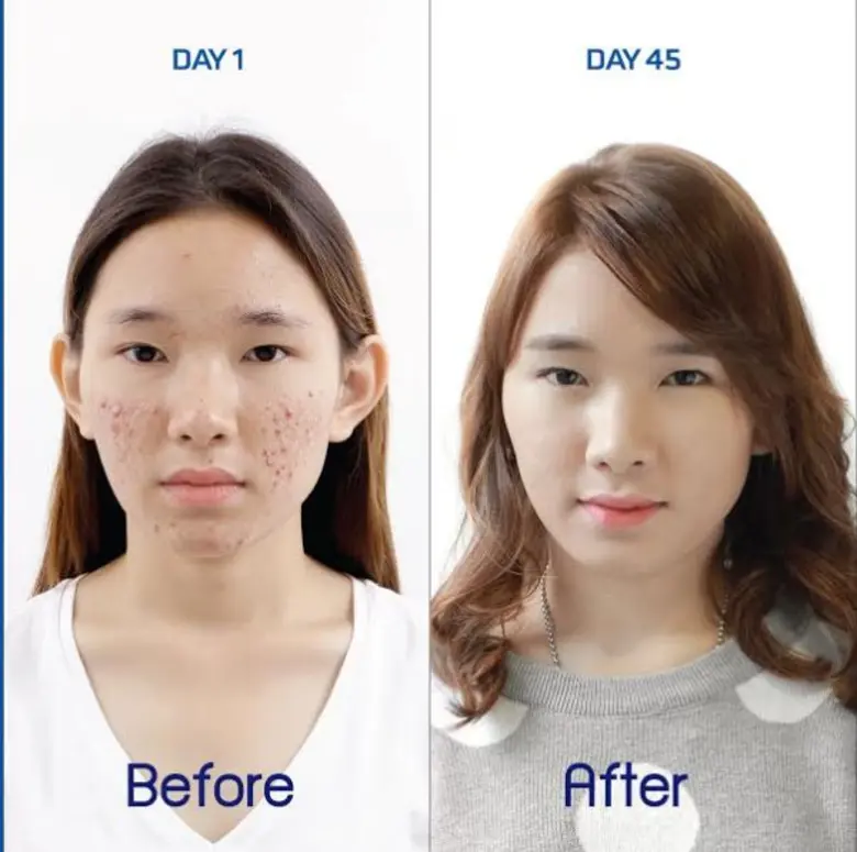 หน้าใส ไม่ต้องพึ่งแอพด้วย E-Lase Plus Program ลบรอยแดง กำจัดรอยดำ แบบอยู่หมัด!