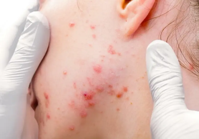 สเตียรอยด์ ... สวยอันตรายที่ตามองไม่เห็น