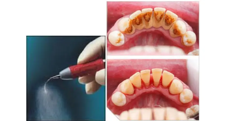 เป็นการขจัดคราบจุลินทรีย์ และคราบหินน้ำลา...
