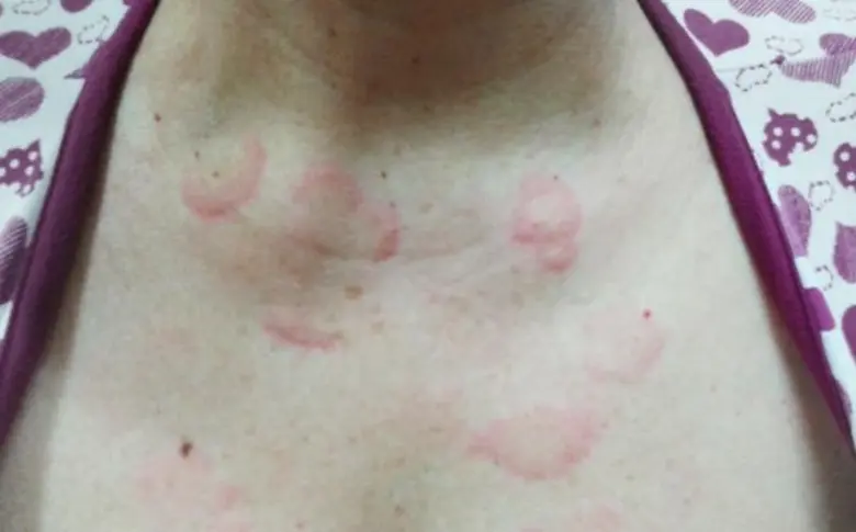 ศิริราชห่วงใย ให้ความรู้คนไทยเกี่ยวกับโรคลมพิษ