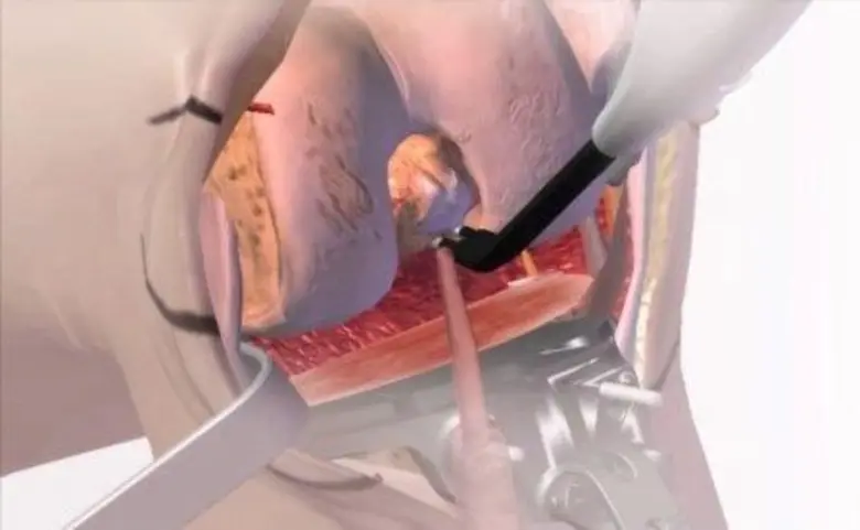 แพทย์ไทยโชว์ฝีมือผ่าตัดเปลี่ยนข้อเข่าเทียม แบบเจ็บน้อย ฟื้นไว เดินได้ใน 24 ชม.