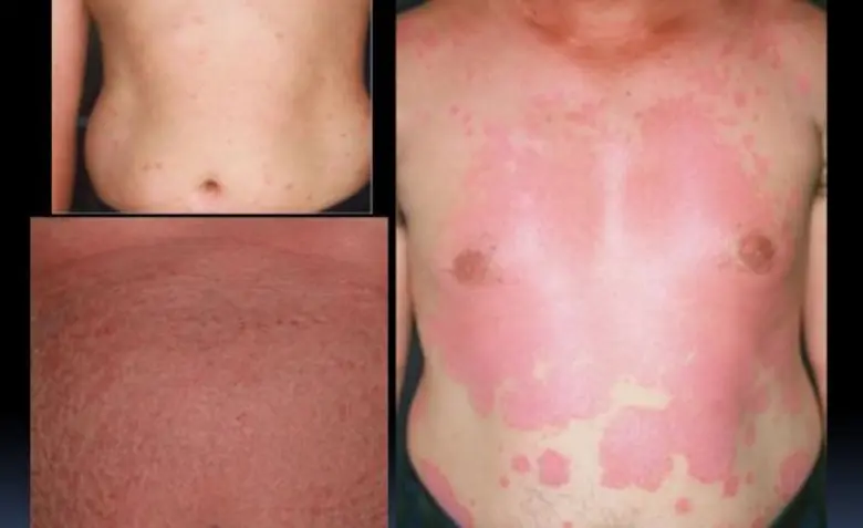 รอยยิ้ม กำลังใจ สานสายใย ผู้ป่วยโรคสะเก็ดเงิน