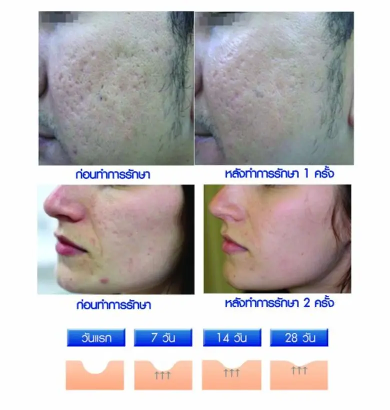 คุณรู้หรือไม่ว่า? ทำไมเวลาเป็นสิวจึงต้องร...