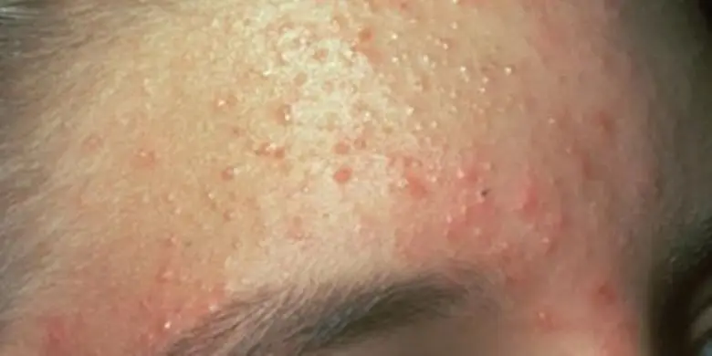 โรคผิวหนัง...ฮอตฮิต (HOT HIT) ช่วงหน้าร้อน