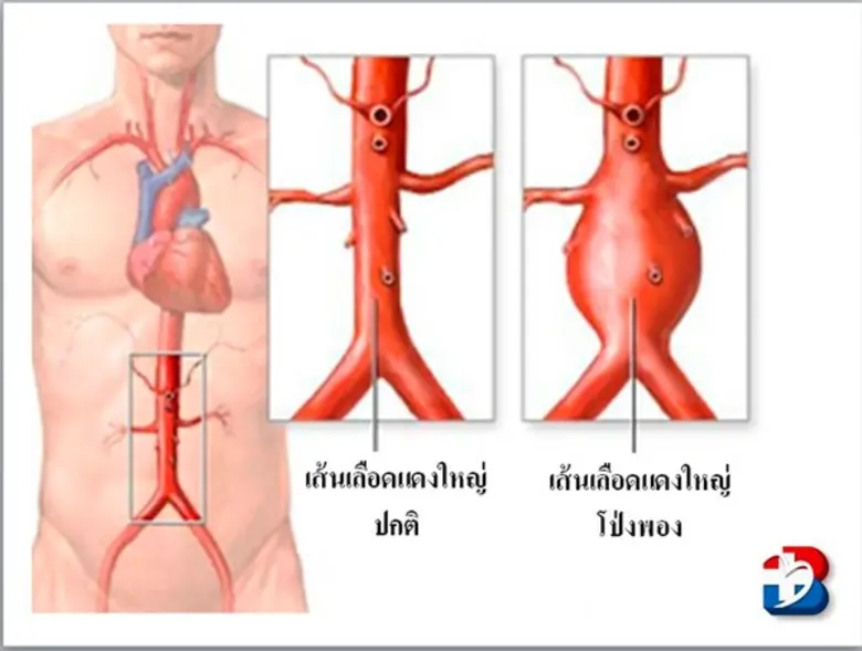 ปัจจุบันโรคหัวใจในไทยยังคงเพิ่มขึ้นอย่างต...