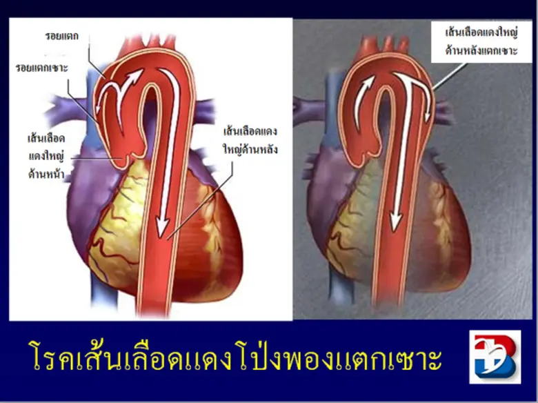 รพ.หัวใจกรุงเทพ เผยพบโรคซับซ้อนทางด้านหัวใจคร่าชีวิตคนไทยเพิ่มขึ้น ลิ้นหัวใจรั่ว-หลอดเลือดแดงใหญ่โป่งพอง เร่งให้รู้ก่อน ตรวจรักษาได้เร็ว ด้วยทีมแพทย์ผู้เชี่ยวชาญ ช่วยให้อัตรารอดชีวิตสูงขึ้น