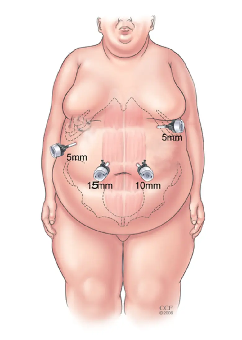 รพ.กรุงเทพ เผยยิ่งอ้วนมาก! โรคแทรกซ้อนยิ่งอันตราย แนะเทคนิคผ่าตัดลดขนาดกระเพาะอาหาร เพื่อลดน้ำหนัก รักษาโรคอ้วน ลดเสี่ยง ลดโรค