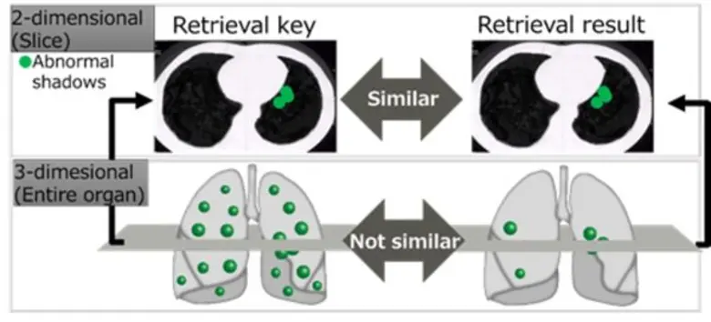 ฟูจิตสึต่อยอดเทคโนโลยี AI ดึงข้อมูลซีทีสแกนของเคสผู้ป่วยที่คล้ายคลึงกัน มหาวิทยาลัยฮิโรชิม่าระบุ เทคโนโลยีใหม่มีความแม่นยำสูงในการดึงข้อมูลเคสผู้ป่วยที่คล้ายกัน