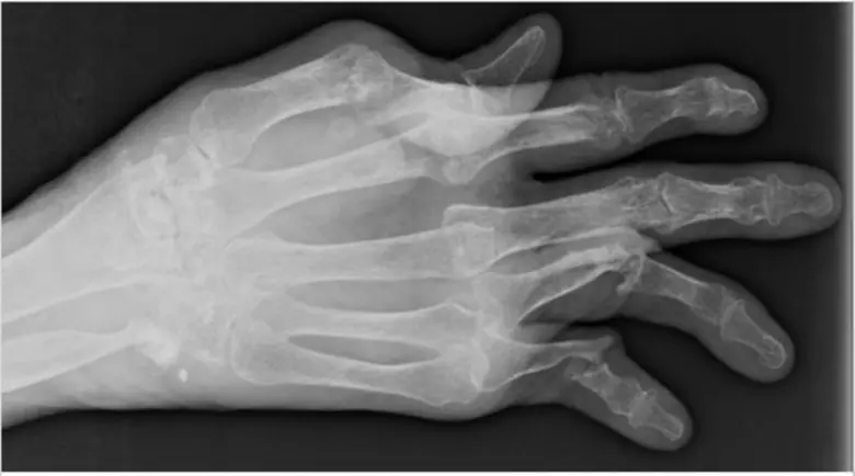 "โรคสะเก็ดเงิน" เป็นโรคเรื้อรังที่ยังไม่ท...