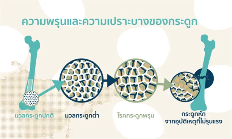 ราชวิทยาลัยแพทย์ออร์โธปิดิกส์แห่งประเทศไทย จัดโครงการรณรงค์ลดการหักซ้ำของกระดูกสะโพกในผู้สูงอายุ และเนื่องในวันโรคกระดูกพรุนโลก