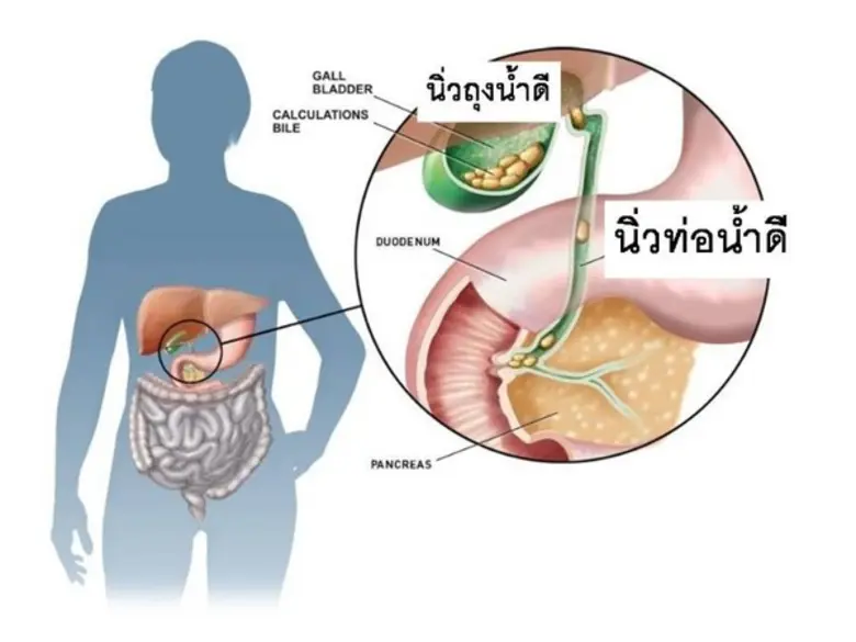 แพทย์เตือนกลุ่มเสี่ยง 4F "ผู้หญิง-อ้วน-วั...