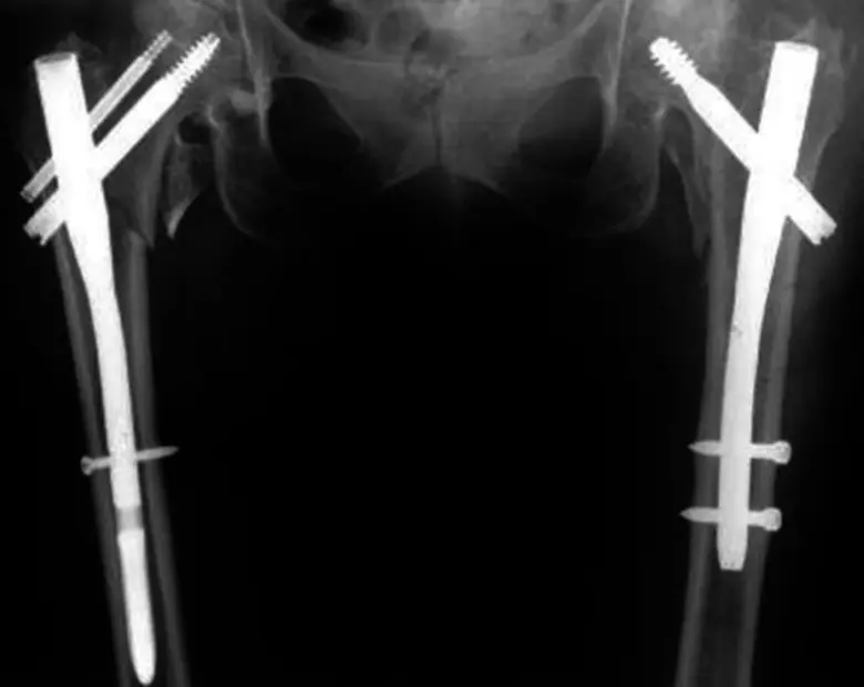 'กระดูกพรุน' ภัยร้าย! คนสูงวัย สะสมแคลเซียมป้องกันได้