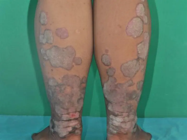 โรคสะเก็ดเงิน (Psoriasis) เป็นโรคเรื้อรัง...