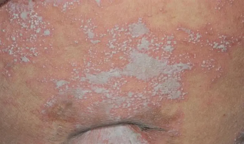 โรคสะเก็ดเงิน . . . อยู่เป็น (ก็) สุขได้