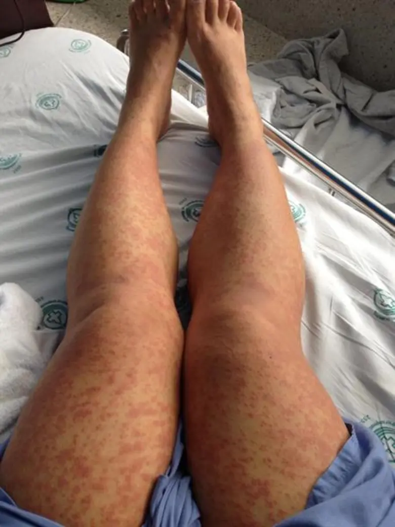 สมาคมแพทย์ผิวหนังแห่งประเทศไทย เตือนหญิงต...