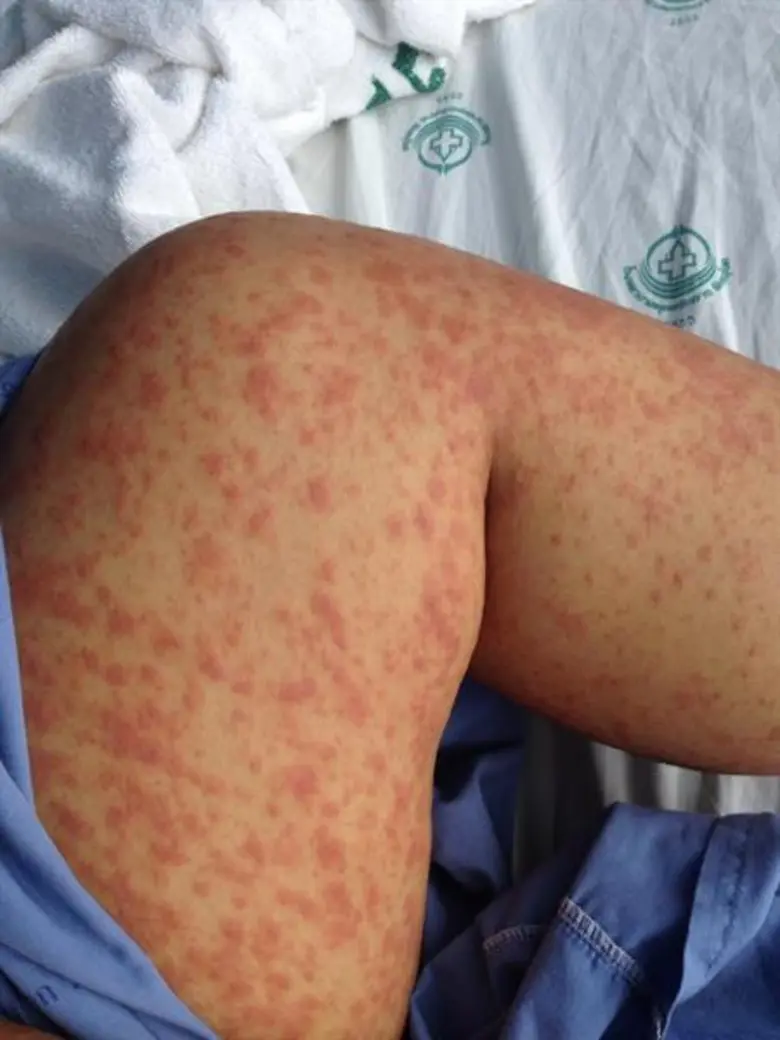 เตือนภัยยารักษาสิวเสี่ยงทำให้เด็กพิการ