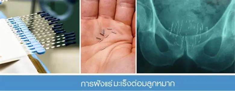 นวัตกรรม “ฝังแร่”ทางเลือกใหม่ของผู้ป่วยมะเร็งต่อมลูกหมาก