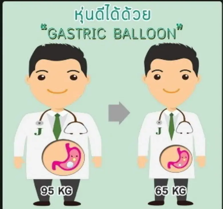 วิธีที่ปลอดภัยด้วยการลดความอ้วน ด้วยบอลลูนกระเพาะอาหาร (Gastric Balloon)