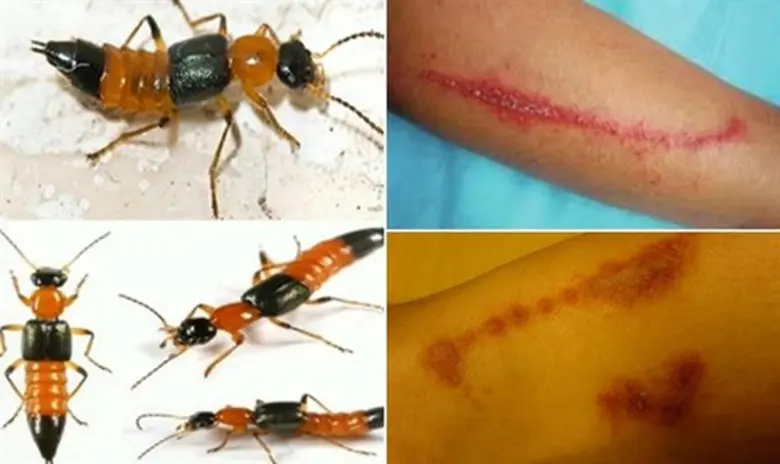 เฝ้าระวังโรคผิวหนังและแมลงสัตว์มีพิษในช่วงฤดูฝน