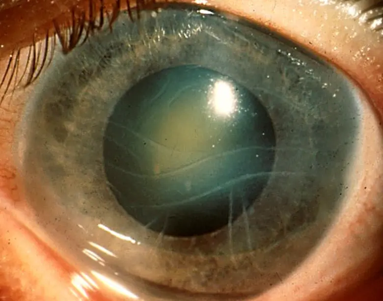 หมอเตือนด่วนห้ามซื้อ "ยาหยอดตาสเตียรอยด์" เสี่ยงตาบอดจากต้อหิน