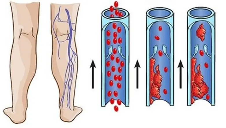 เมื่อพูดถึงโรคหลอดเลือดซึ่งเป็นสาเหตุของก...