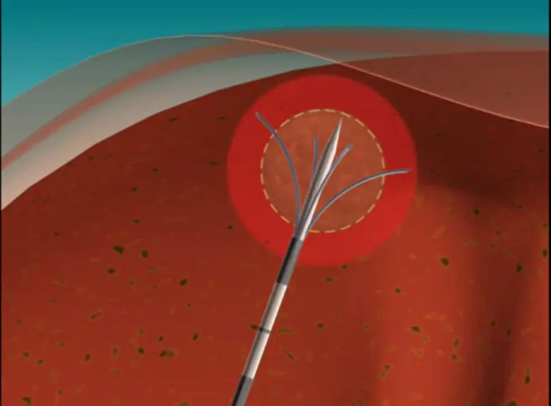 การรักษามะเร็งตับด้วยการให้เคมีบำบัดผ่านทางหลอดเลือด	