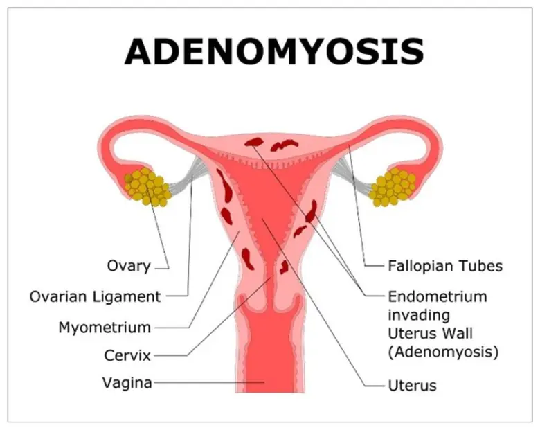  สัญญาณเตือนในผู้หญิง ประจำเดือนมากผิดปกติ เสี่ยงมดลูกโต