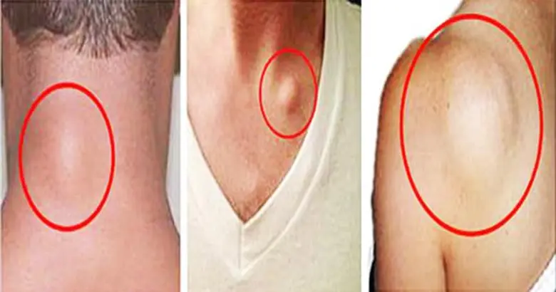 โดย นพ. จินดา โรจนเมธินทร์ อุปนายกและแพทย...