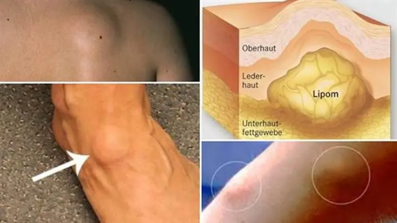 ก้อนที่ผิวหนัง