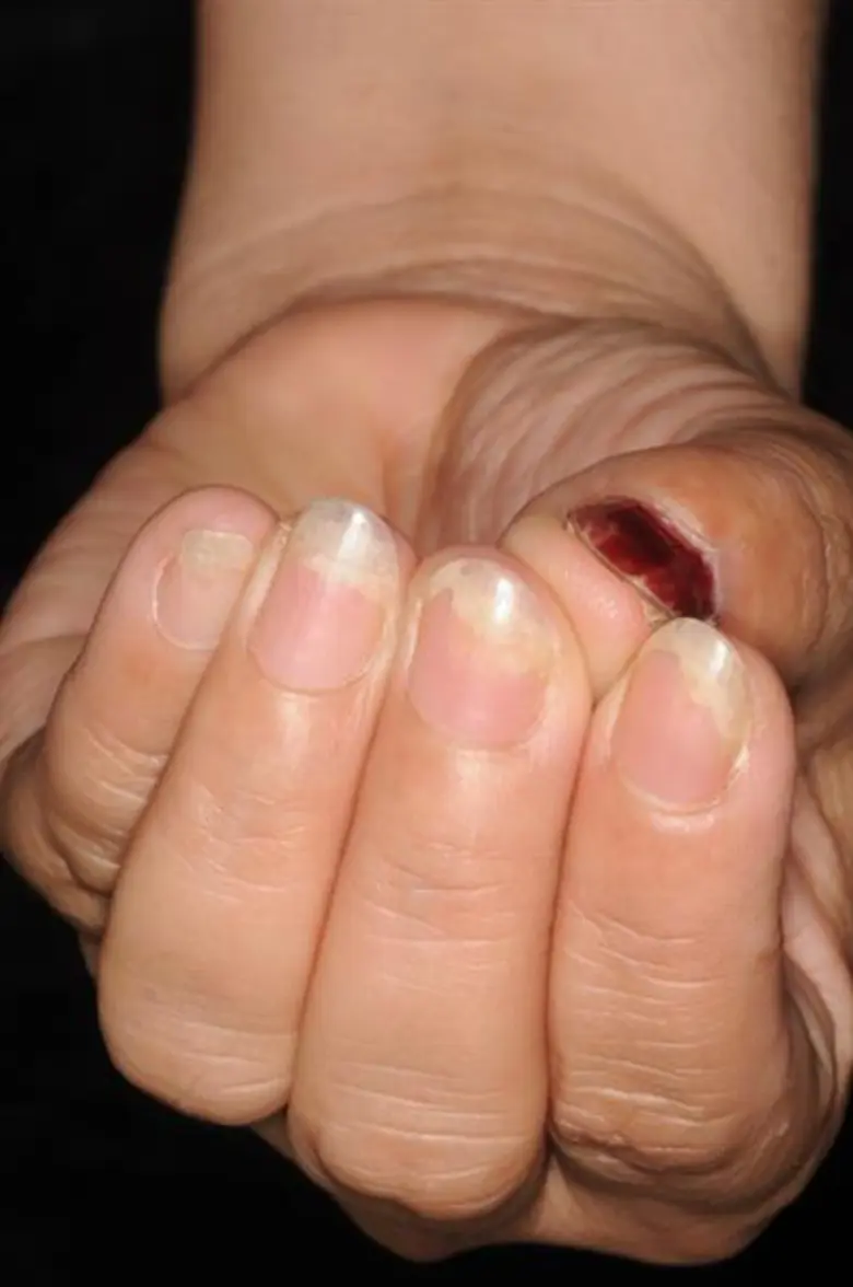 เรื่องเล่าจากหมอผิวหนังฯ :ตอน สังเกตเล็บช่วยบอกโรค