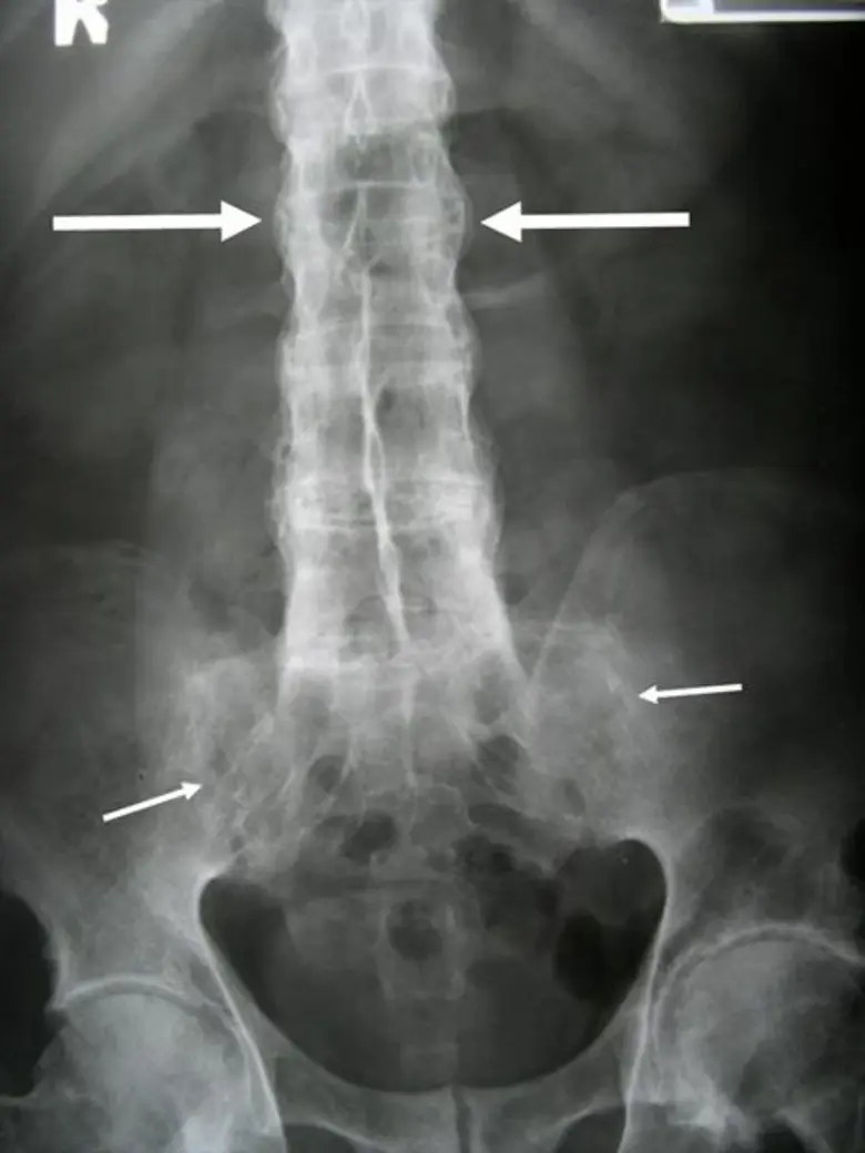 บ่อยครั้งที่คนวัยทำงานอาจมีอาการปวดหลังแบ...