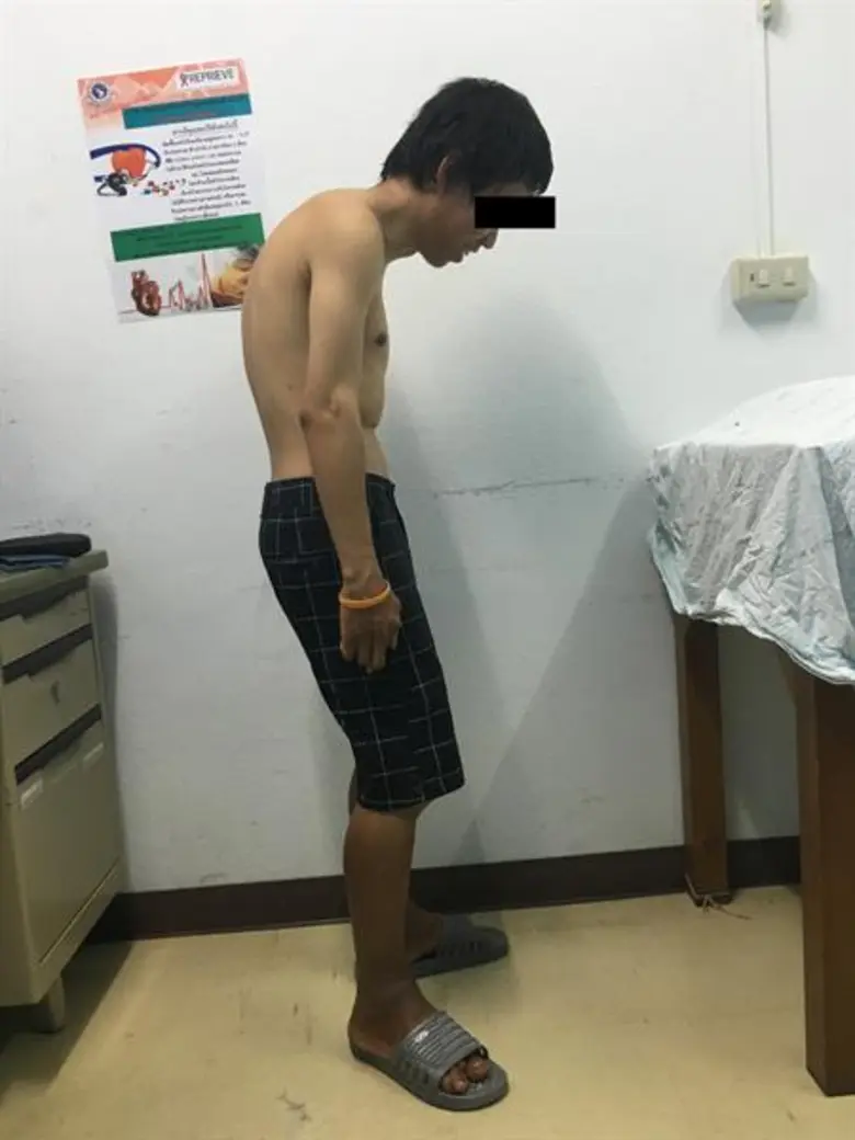 ปวดหลังเรื้อรัง อย่าชะล่าใจ! แพทย์เตือนเสี่ยงโรคข้อกระดูกสันหลังอักเสบชนิดติดยึด