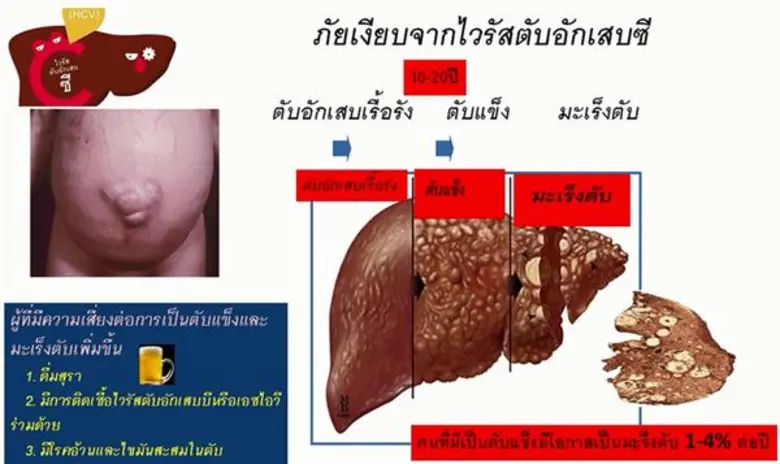 เตือนภัยเงียบไวรัสตับอักเสบซี
