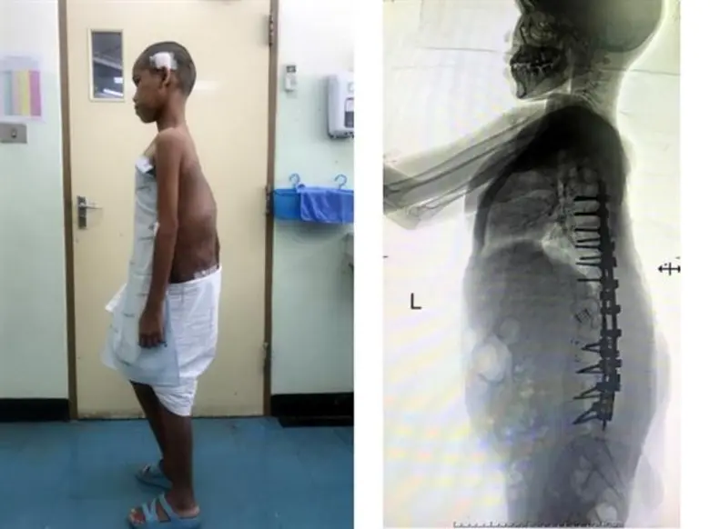 แพทย์ราชวิถี” เปิดนวัตกรรมการผ่าตัดกระดูกสันหลังโก่งสำเร็จด้วยเทคนิคแผลเล็ก แห่งแรกของเอเชีย